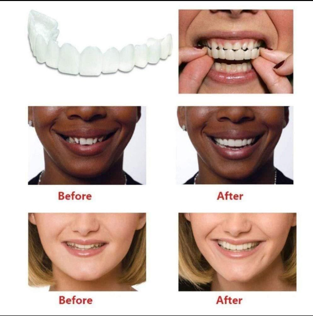 FIT FLEX ADJUSTABLE SNAP-ON DENTURES (Buy 1 Get 1 Free🔥🔥)