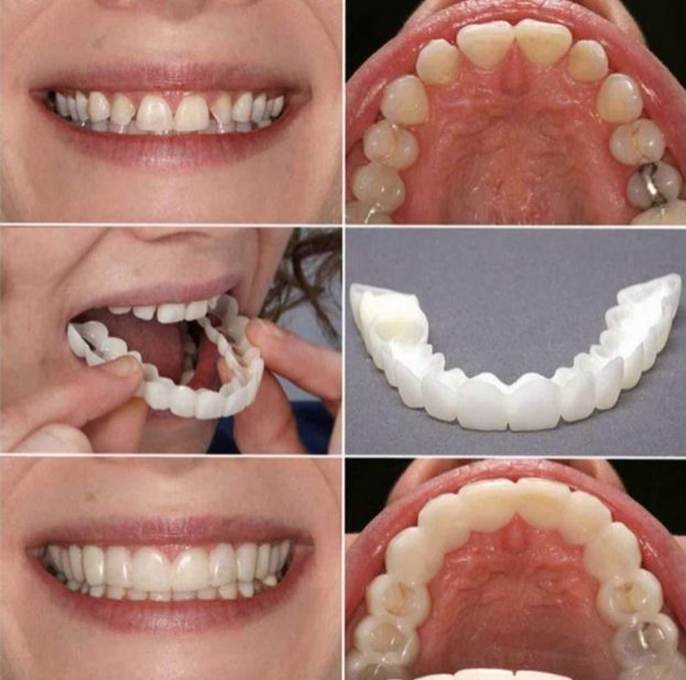 FIT FLEX ADJUSTABLE SNAP-ON DENTURES (Buy 1 Get 1 Free🔥🔥)