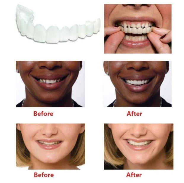 FIT FLEX ADJUSTABLE SNAP-ON DENTURES (Buy 1 Get 1 Free🔥🔥)