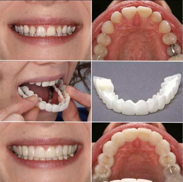 FIT FLEX ADJUSTABLE SNAP-ON DENTURES (Buy 1 Get 1 Free🔥🔥)